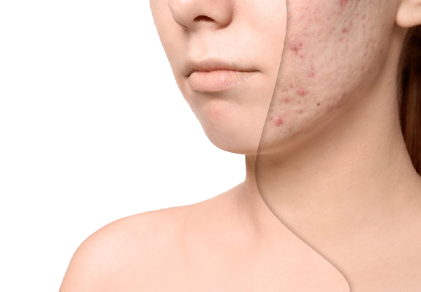 Acne Scar Treatment