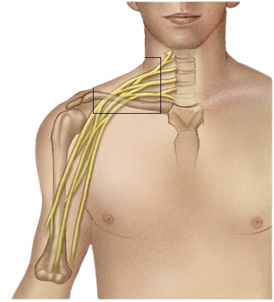 Brachial Plexus Injury