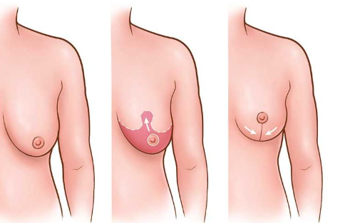 Breast Lift Surgery