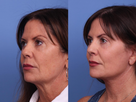 Face Lift Surgery