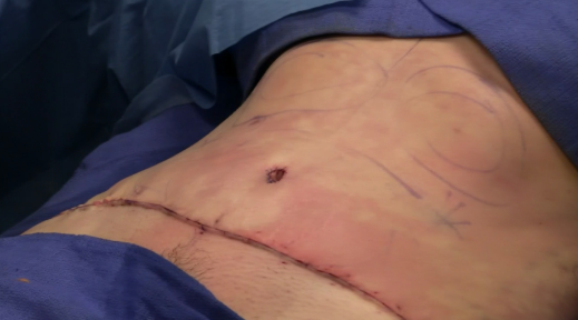 tummy tuck surgery