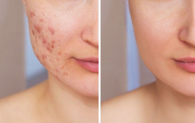 Acne Scar Treatment Gurgaon Can Acne Scars Be 100% Removed