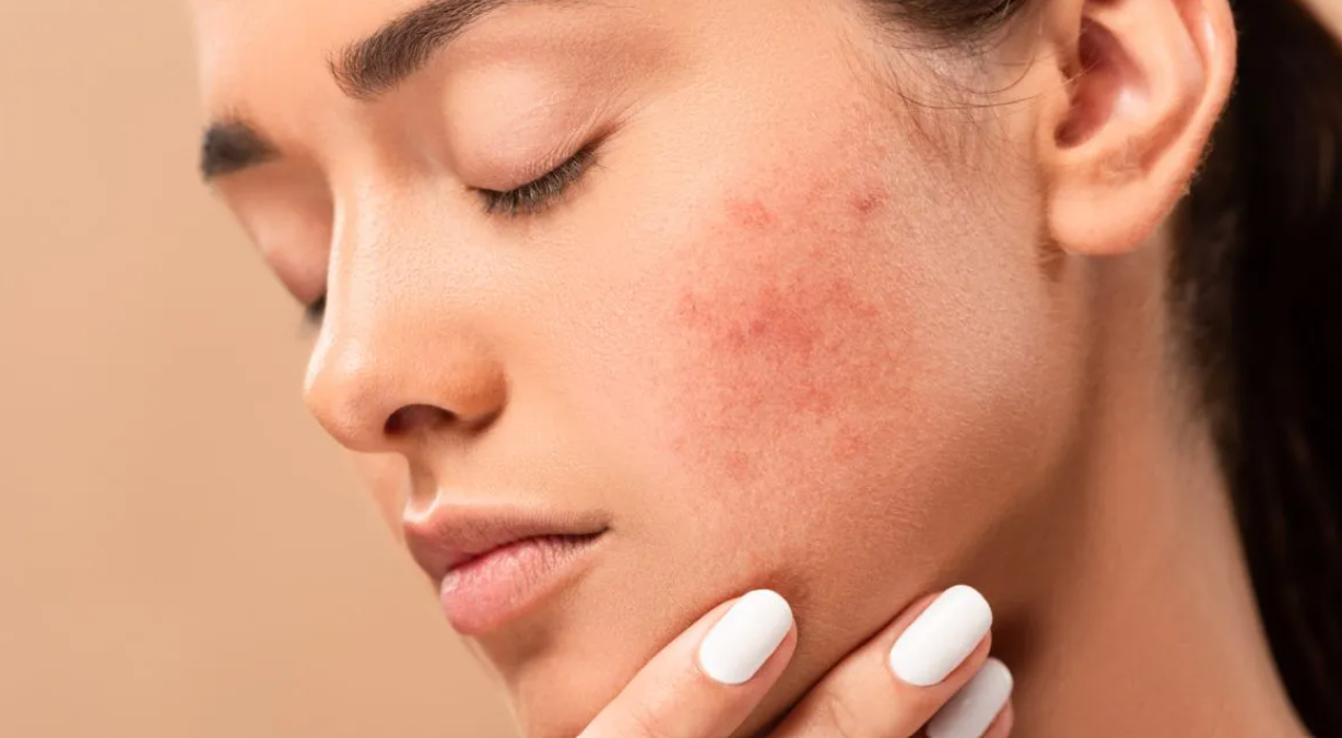 Acne Scar Treatment in Gurgaon Surgical vs Non-Surgical Options Explained