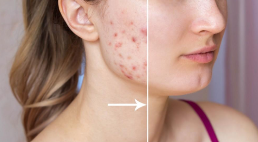 Acne Scar Treatment