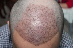 Best Hair Transplant Surgery in Gurgaon – Natural, Permanent Results