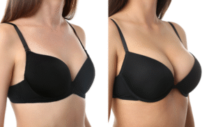 Breast Augmentation Surgery