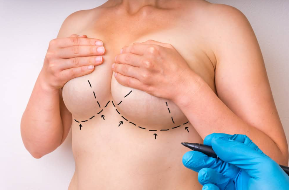 Breast Augmentation Surgery in Gurgaon Expert Guide & Results by Dr. Pradeep Kumar Singh