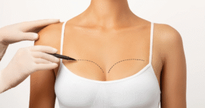 Breast Lift Surgery