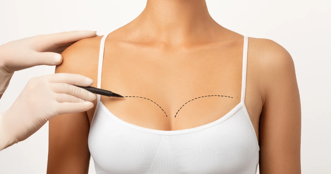 Breast Lift Surgery