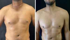 Breast Reduction Surgery