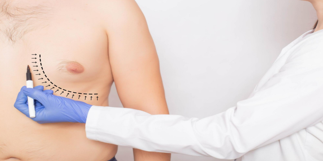Gynecomastia Surgery in Gurgaon