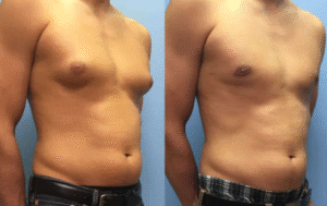 Male Breast Reduction Surgery in Gurgaon A Complete Guide to Treating Male Gynecomastia