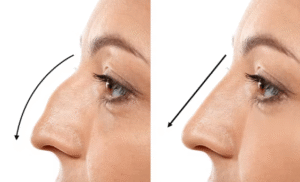 Rhinoplasty Surgery Gurugram What Is the Cost of Rhinoplasty Surgery
