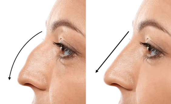 Rhinoplasty Surgery Gurugram What Is the Cost of Rhinoplasty Surgery
