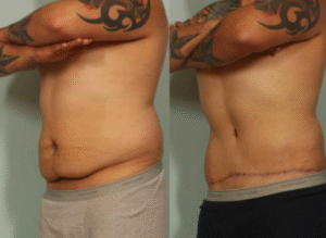 ⭐ Tummy Tuck Surgery Gurgaon What Is Tummy Tuck Surgery A Complete Patient Guide