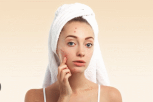 acne scar removal