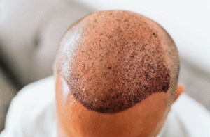 Hair Transplant