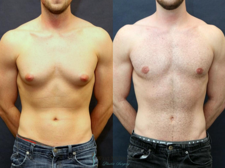 How to Get Rid of Man Boobs Permanently Surgical Solutions