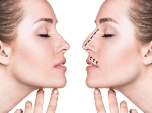 Nose Reshaping Surgery What to Expect at Artemis Hospital