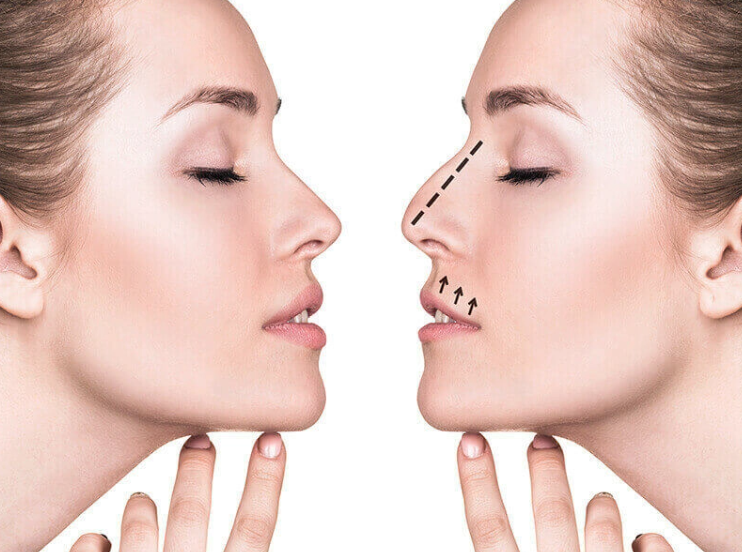 Nose Reshaping Surgery What to Expect at Artemis Hospital