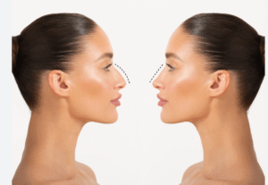 Nose Rhinoplasty