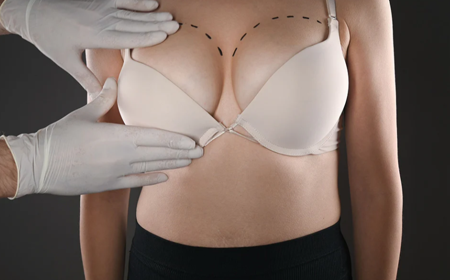 Post-Pregnancy Breast Lift Restoring Your Confidence After Motherhood