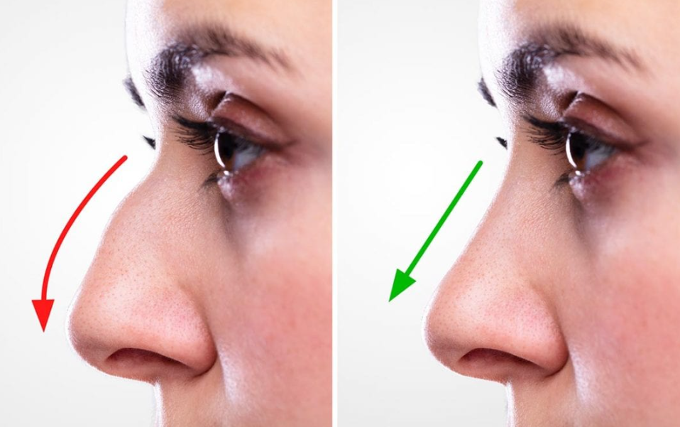Rhinoplasty in 2026 Latest Techniques and Trends in Gurgaon