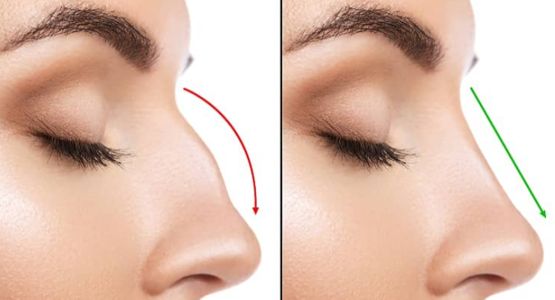 Open vs Closed Rhinoplasty Which Technique Is Better
