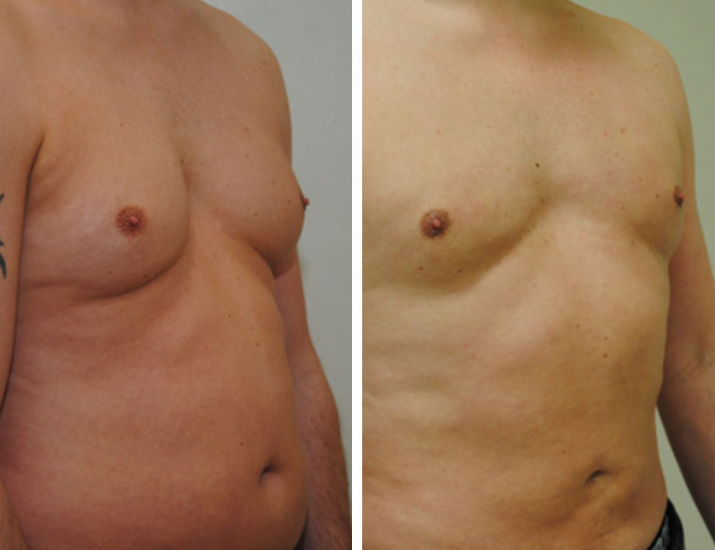Puffy Nipples Treatment in Men